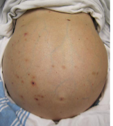 <p>Ascites commonly occurs due to what type of disorders</p>