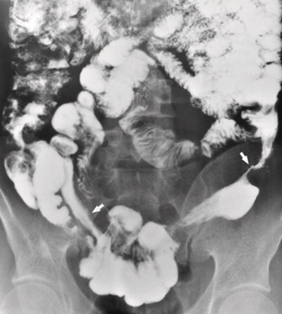 <p>What is the imaging appearance of Crohn's Disease (Regional Enteritis)?</p>