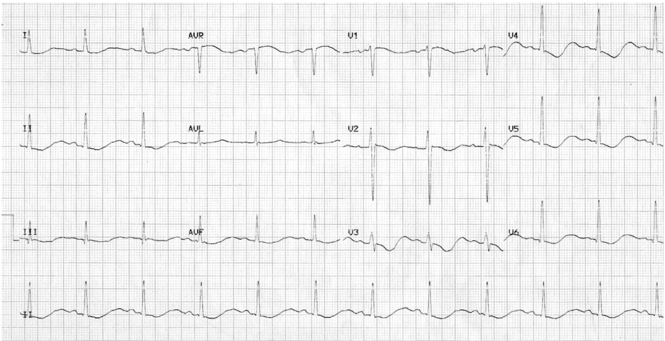 <p>EKG findings for HYPOkalemia</p>