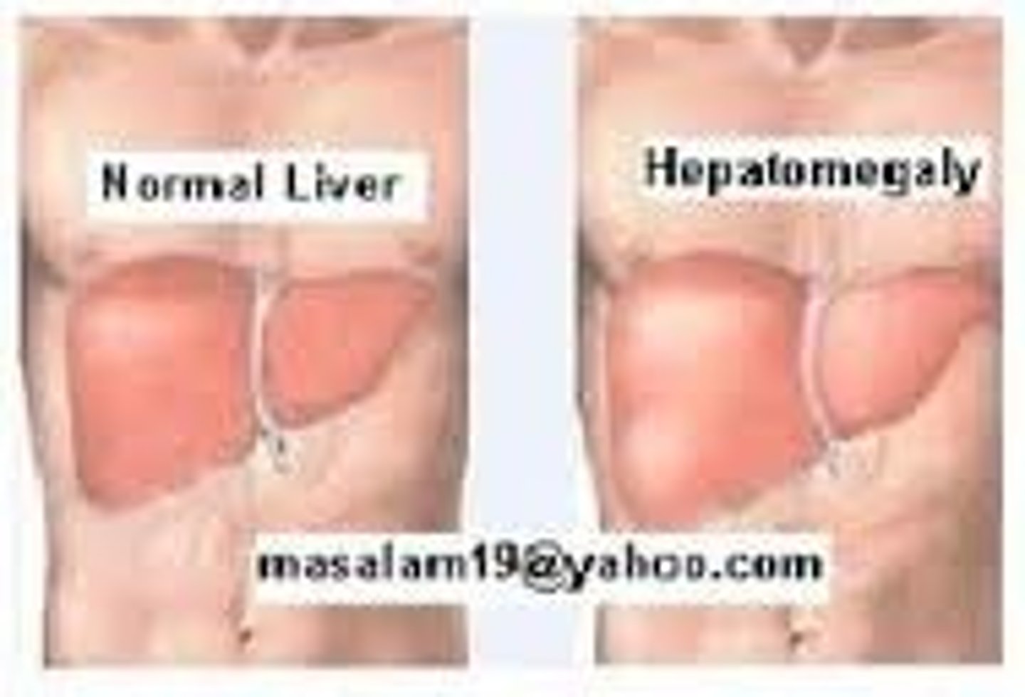 <p>a span greater then 12 cm at midclavicular line and greater then 8cm at midsternal line</p>