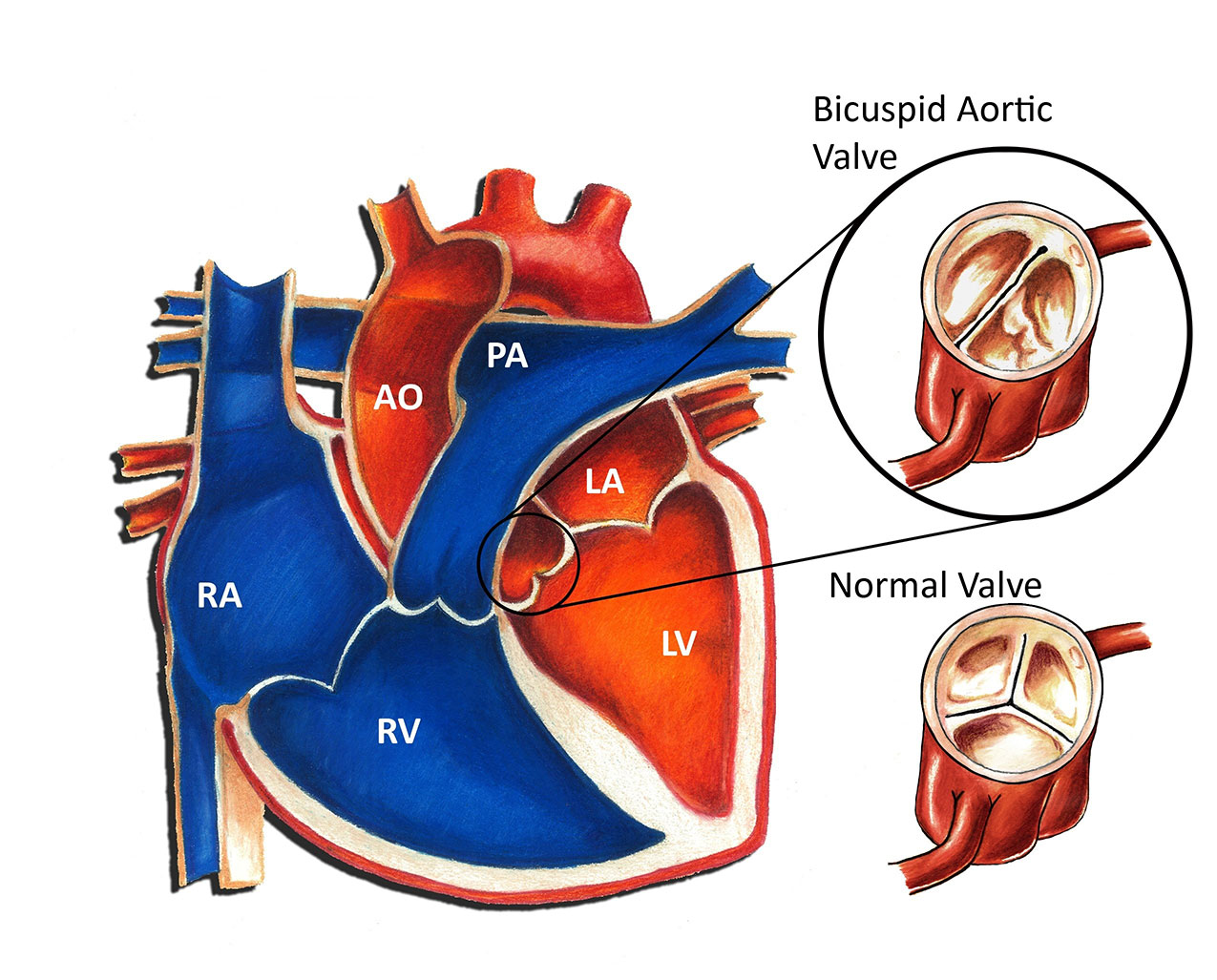 <p>between the LA (left atrium) and LV (left ventricle)</p>