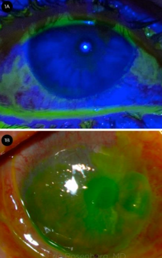 <p>Eyelash condition that is potentially vision and life-threatening</p><ul><li><p>Damages mucous membranes</p><ul><li><p>Acute: conjunctival hyperemia, corneal epithelial defects</p></li><li><p>Chronic: severe cicatrization of lids and conjunctiva (→ trichiasis)</p></li></ul></li></ul><p></p>