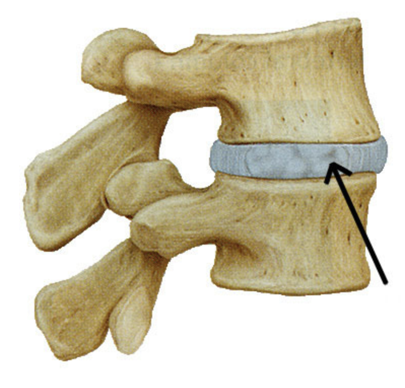 cartilaginous

bodies of adjacent vertebrae