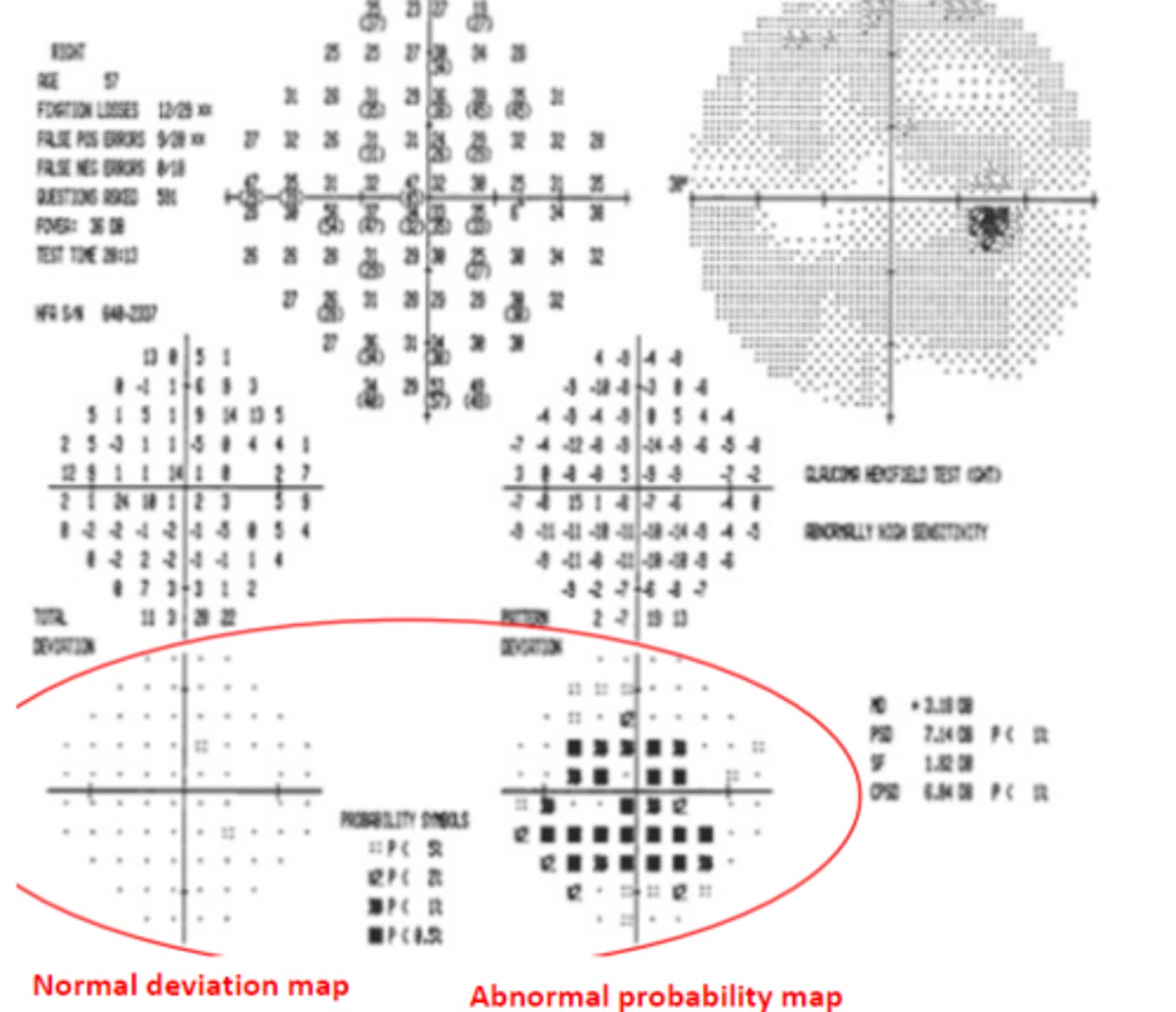 <p>A _____ can be seen when the patient is "trigger happy" and having a high number of false positives. Will also have higher fixation losses and a probably map that looks abnormal with a normal total deviation map.</p>