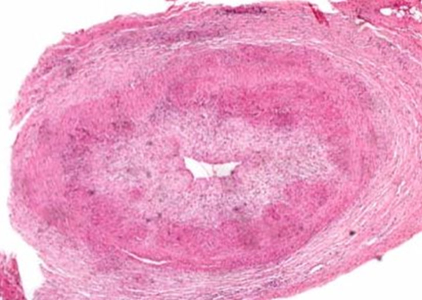 <p>What is the pathophysiology behind <strong>GCA</strong>?</p>