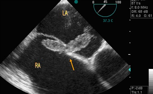 <p>A patient is referred to the echo lab because of symptoms of TIA's.&nbsp; The patient had an echo previously which showed a small patent foramen ovale.&nbsp; A TEE is performed and reveals the above diagnosis.</p><p></p><p>Normal inter-atrial septum</p><p></p><p>Catheter protruding through the intra-atrial septum</p><p>&nbsp;</p><p>A large clot lodged in the patent foramen ovale</p><p>&nbsp;</p><p>An ASD closure device</p>