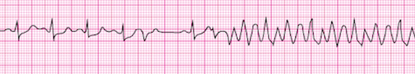 <p>Identify the rhythm.</p>