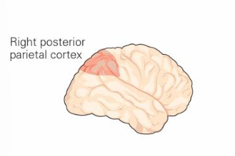<p>A condition where a patient fails to attend to stimuli on one side of space, typically the left. It is caused by damage to the <strong>right parietal cortex</strong></p>