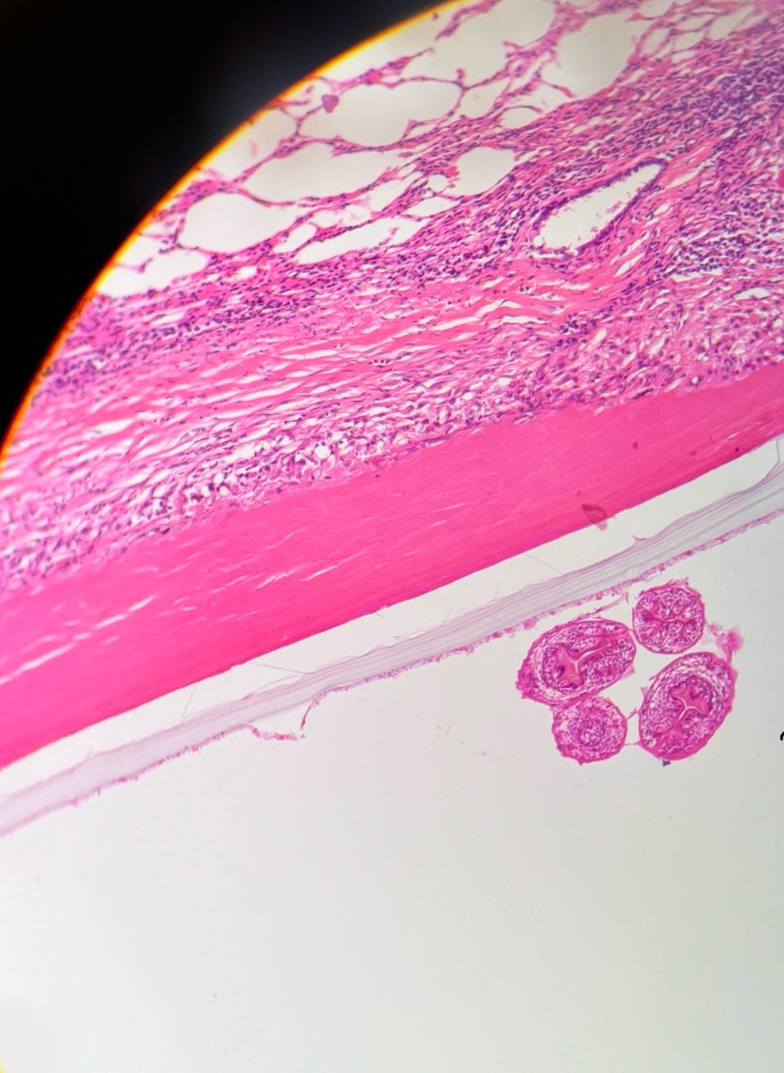 <p>the hydatid cyst is the larvae form and it can be very harmful to humans. the thick outer cyst, composed of fibrous connective tissue produced by the host. within this is a thin germinal membrane to which the daughter cyst are attached. each of the latter contains either one or more invaginated scolices or several small brood capsules. The scolices are produced by endogenous budding capsules. All of the cysts is confined within one large spherical cyst embrace, hence the term “unilocular”. Spces within the cyst are filled with hydatid fluids. </p>