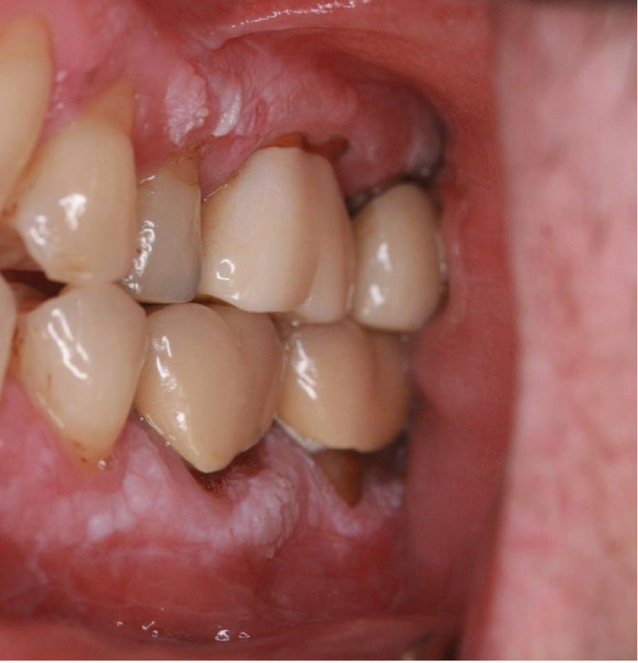 <p>which neoplastic white lesion:</p><ul><li><p>70% malignant transformation</p></li><li><p>mortality rate of 30-40%</p></li><li><p>Patients in their 6th decade (or older) and females (4x likely)</p></li><li><p>Unclear associated risks Gingiva, alveolar and palatal mucosa</p></li><li><p>?prognosis</p></li></ul><p></p>