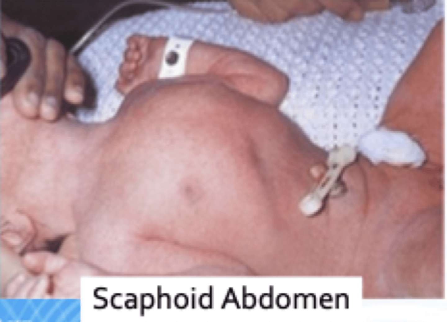 <p>abnormal displacement of organs through the diaphragm</p>