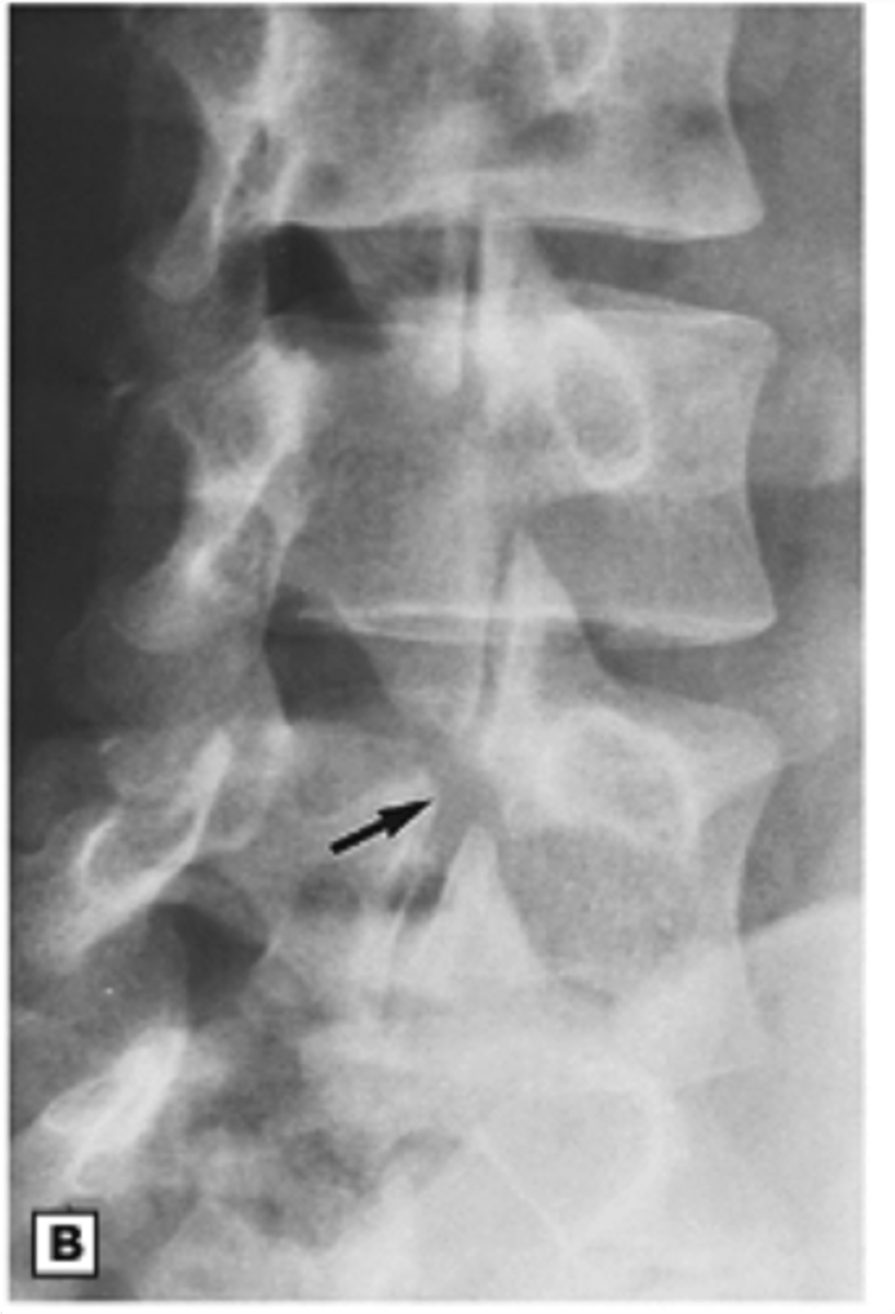 <p>Spondylolysis (note: when you get bilateral par defects, you could develop spondylolythesis--this is especially common in extension-based athletes like gymnasts or offensive linemen)</p>