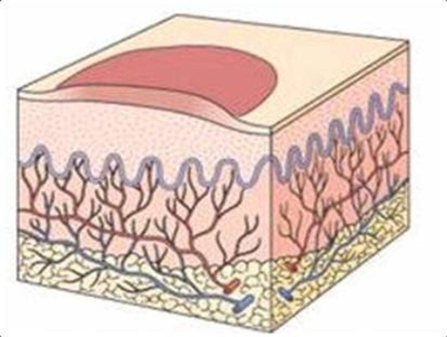 <p>An epidermal fluid collection greater than 5mm in diameter.</p>