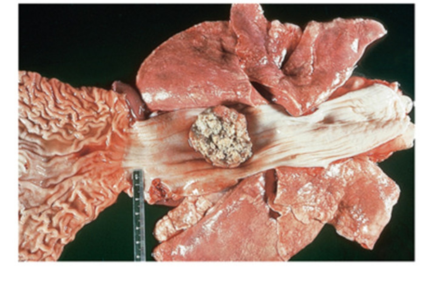 <p>The adult esophageal worm is associated with nodule formation in the esophagus of dogs and cats. The genus and species of this nematode is</p>