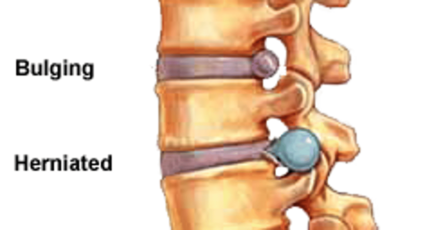 <p>slight deformity in the nucleus</p>