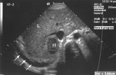 What is the echogenicity of the mass in the liver?