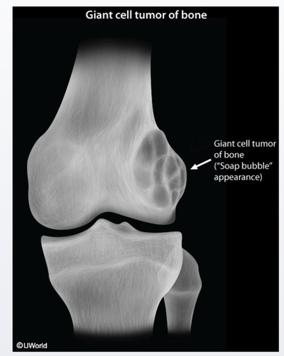 <p>Giant cell tumor of bone is a benign and locally aggressive skeletal neoplasm that usually presents with pain, swelling and decreased range of joint motion at the involve site. It typically presents as osteolytic (with a soap-bubble appearence on radiographs) in the epiphyseal regions of the long bones and most commonly involves the distal femur and proximal tibia around the knee joint</p>