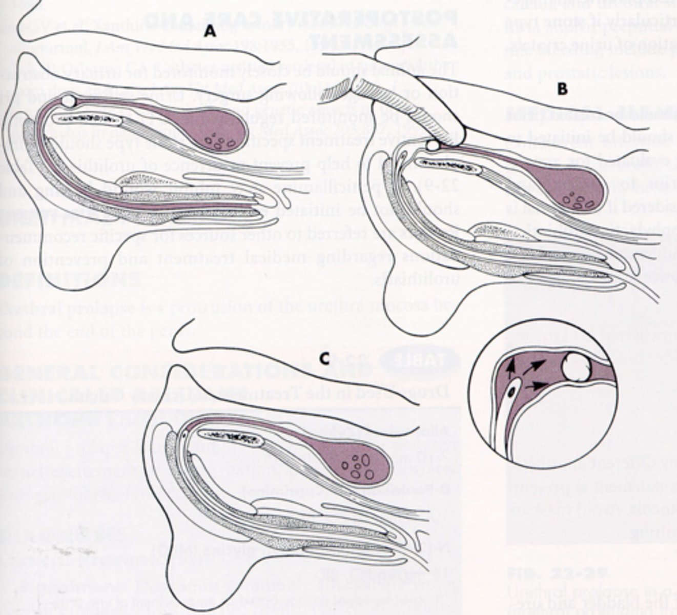 <p>What is this, where the goal is to propel urethral stones back into the bladder by dilating the urethra?</p>