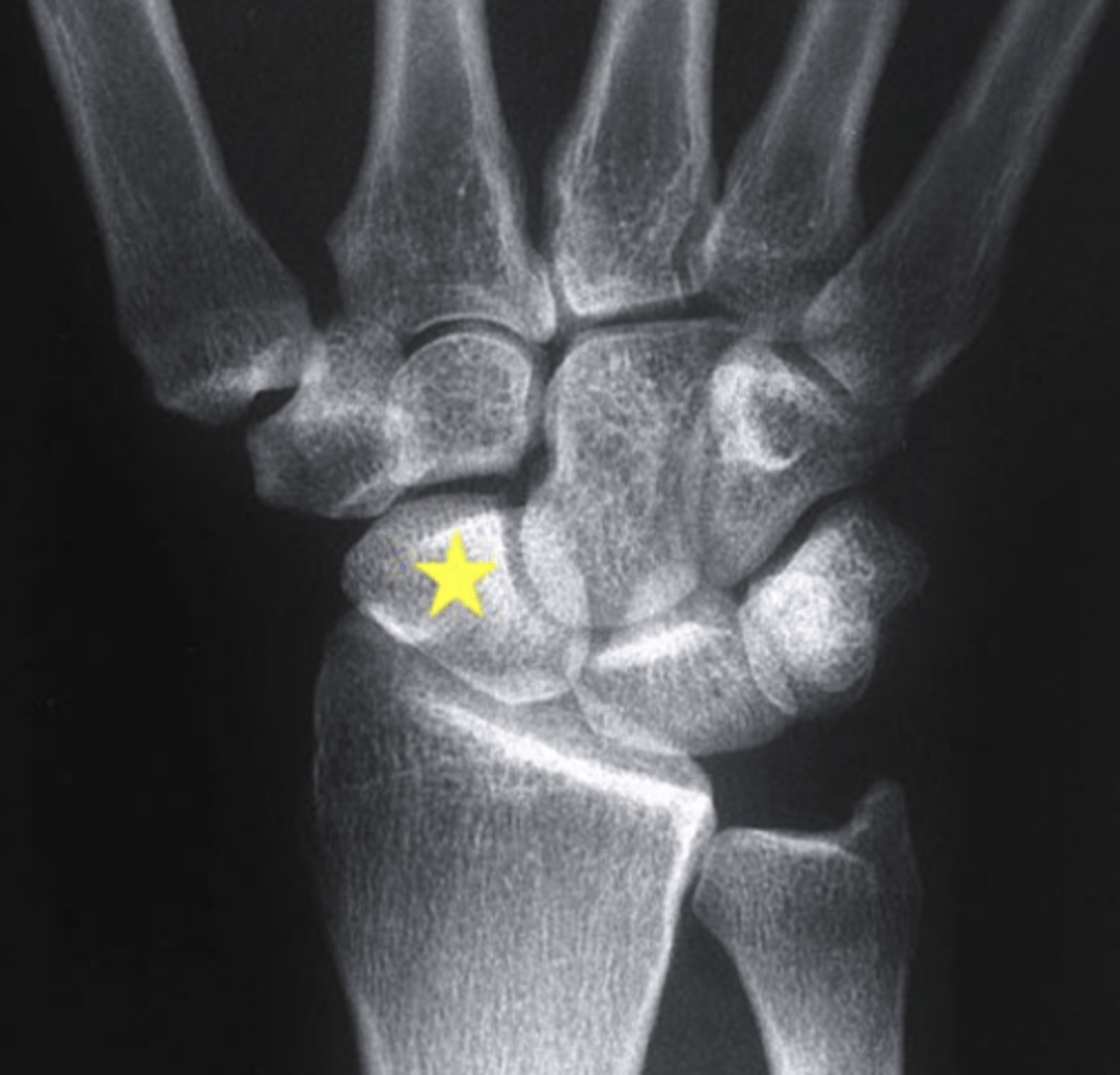 <p>scaphoid</p><p>3 multiple choice options</p>