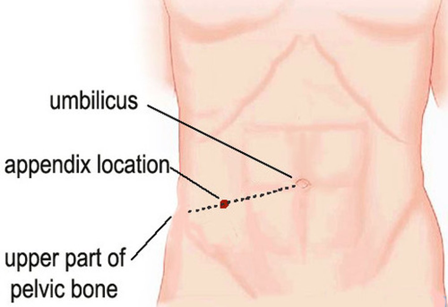 <p>Abrupt onset pain in epigastric/periumbilical area</p><p>Increases in intensity over time</p><p>Rebound tenderness (Blumberg's sign)</p><p>Point tenderness at McBurney's point (site of the appendix located 1.5-2" above ASIS in right lower quadrant</p>