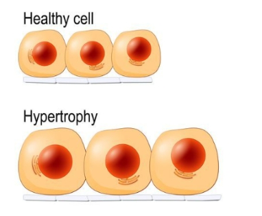 <p>Hypertrophy</p>