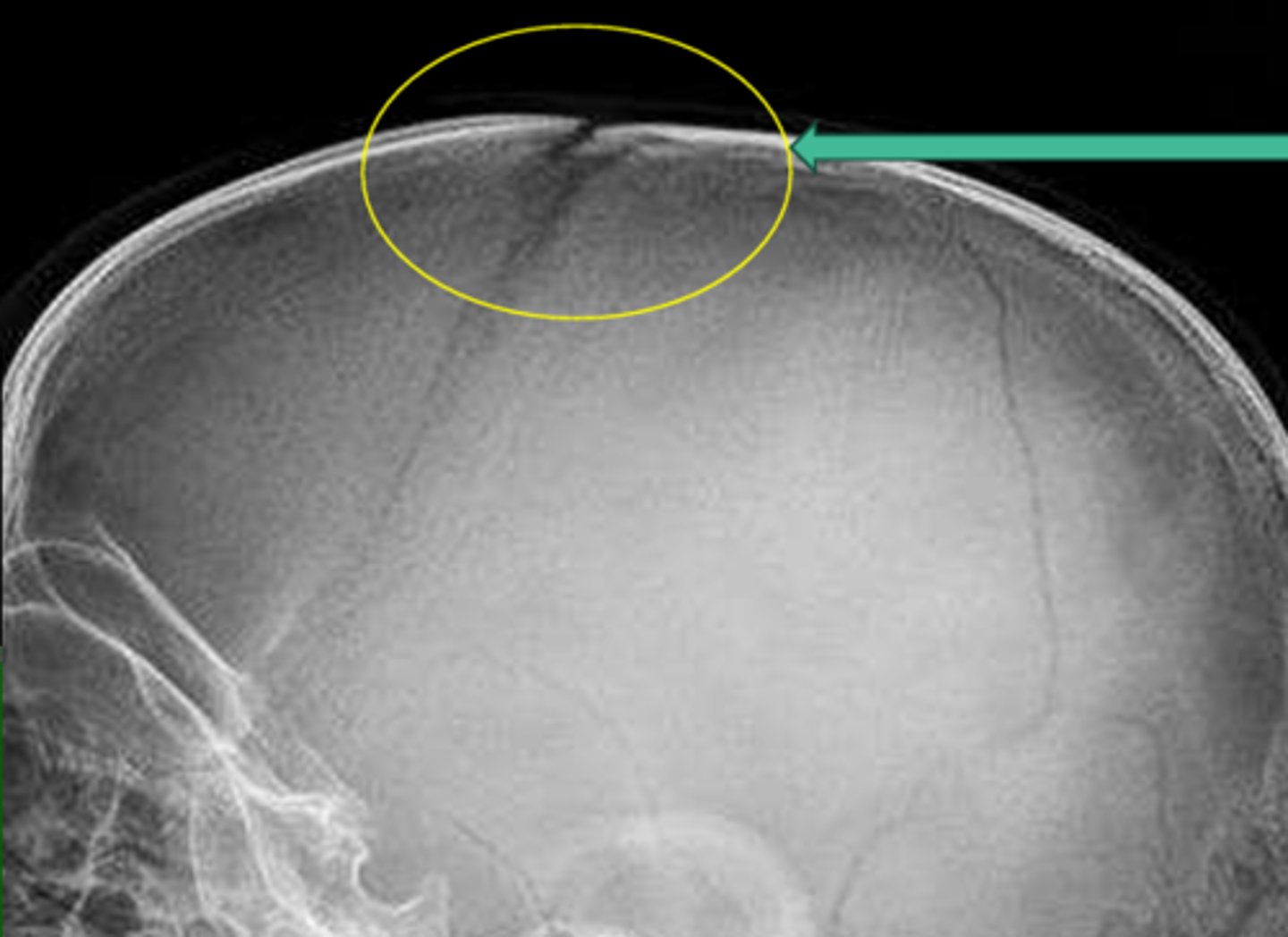 <p>What type of fracture is this?</p>