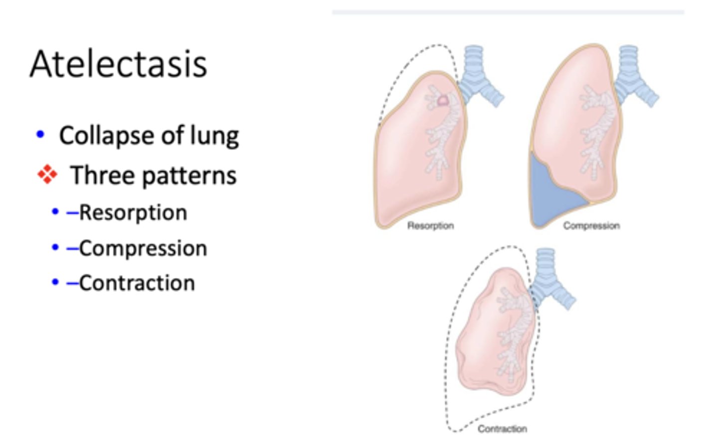 <p>- Resorption</p><p>- Compression</p><p>- Contraction</p>