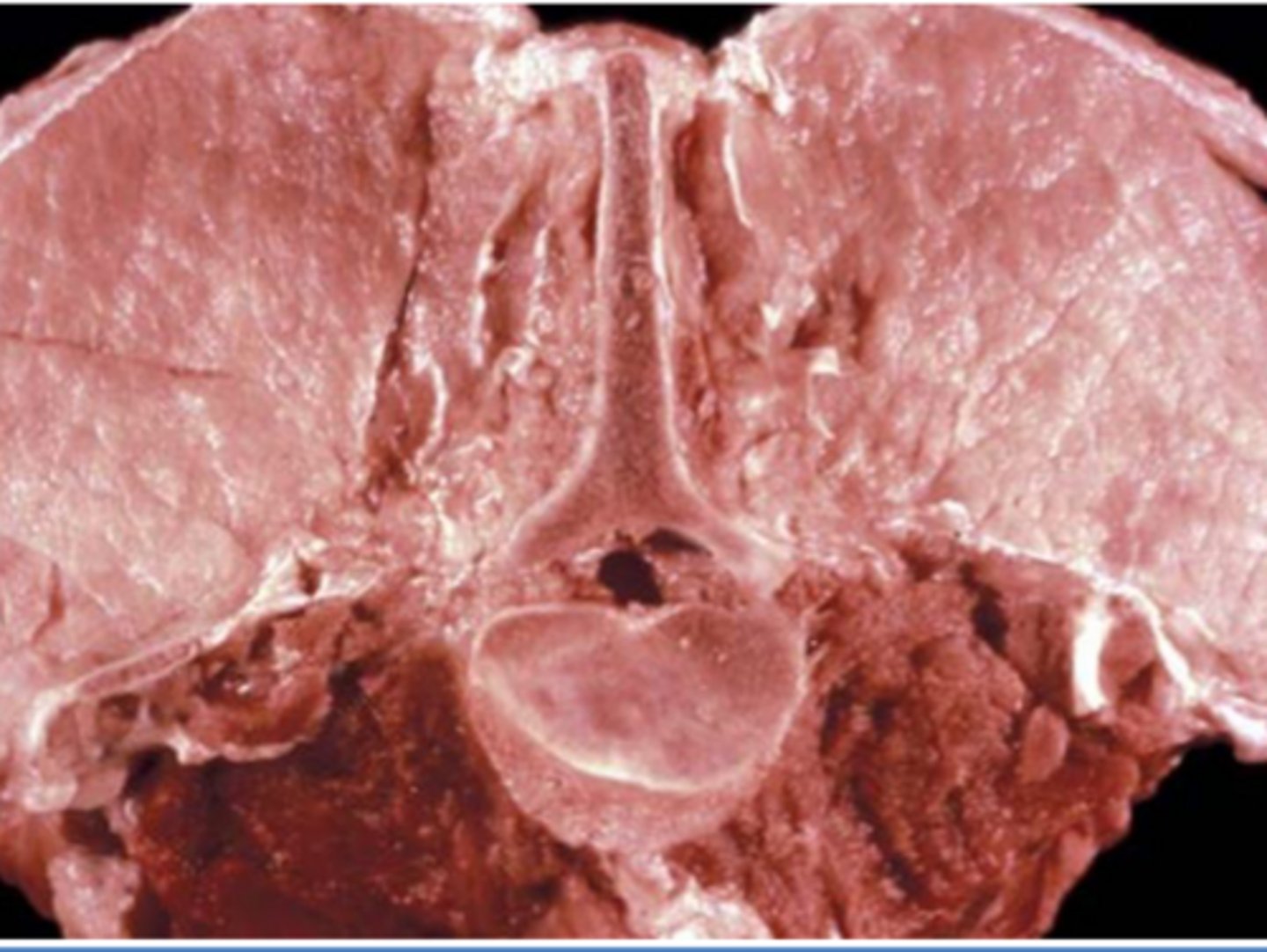 <p>What is malignant hyperthermia?</p>