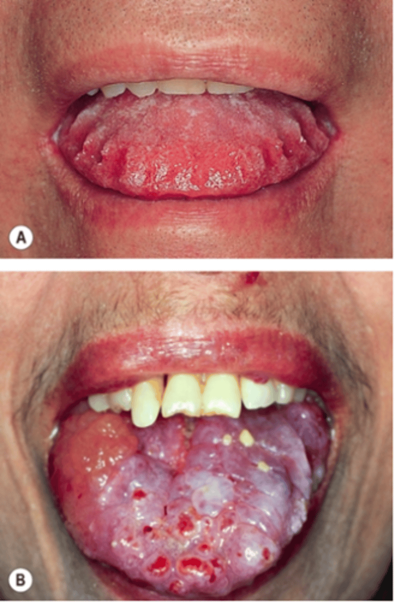 <p>most cases idiopathic</p>