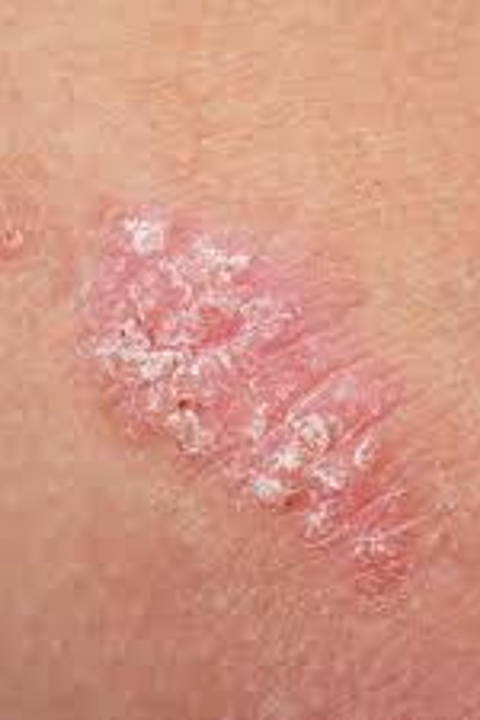 <p>Autoimmune disorder causing itchy, red scaling skin</p>