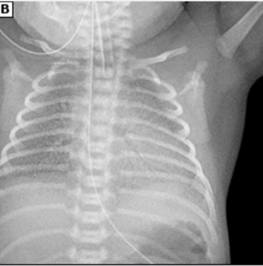 <p><strong>RDS: Diagnosis</strong></p><p>-________ infant with progressive respiratory distress/failure shortly after birth</p><p>-CXR shows ___ lung volume, diffuse ______ _______ appearance with air bronchograms. This is a result of alveolar atelectasis contrasting with aerated airways </p><p></p>
