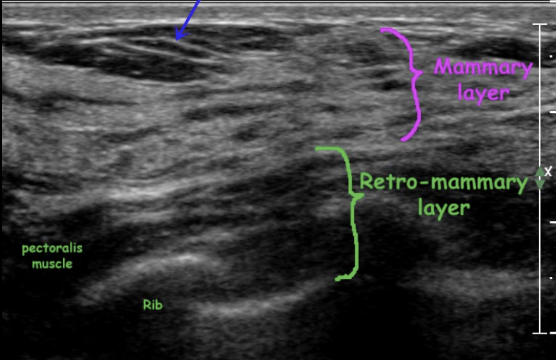 <p>Normal breast tissue</p>