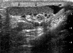 <p>What structure is seen here, as indicated by the arrow?</p>