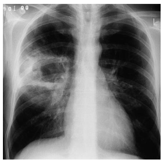 <p>hematogenous - septic emboli/R side endocarditis/IV device</p><p>risk factors: viral respiratory infection (influenza or measles), cystic fibrosis, healthcare contact, aspiration </p>