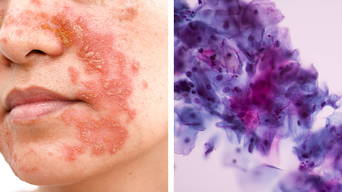 <p>BLASTOMICES DERMATITIDIS BLASTOMICOSIS</p><p></p>
