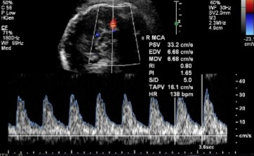 <p>Doppler of the MCA was done and this was seen. </p><ol><li><p>Is this waveform normal or abnormal?</p></li><li><p>If abnormal, what pathology can it be indicative of?</p></li></ol><p></p>