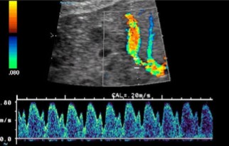 <ol><li><p>What vessel is being dopplered here?</p></li><li><p>Is this waveform normal or abnormal?</p></li></ol><p></p>
