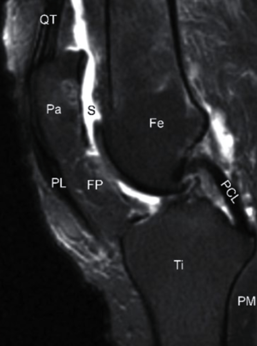 <p>what does the S represent on this image and what type of image is this?</p><p>a. Swelling, T1 MRI</p><p>b. Sclerosis, T1 MRI</p><p>c. Synovial Fluid, T2 MRI</p><p>d. Sartorius, T2 MRI</p>