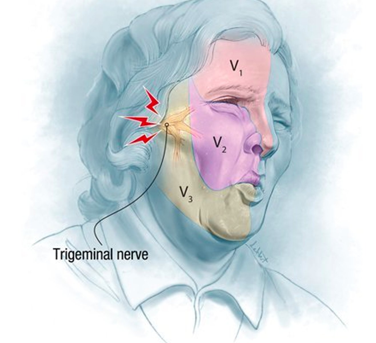 <p>inflammation of CN V (trigeminal) due to compression near brain stem</p>
