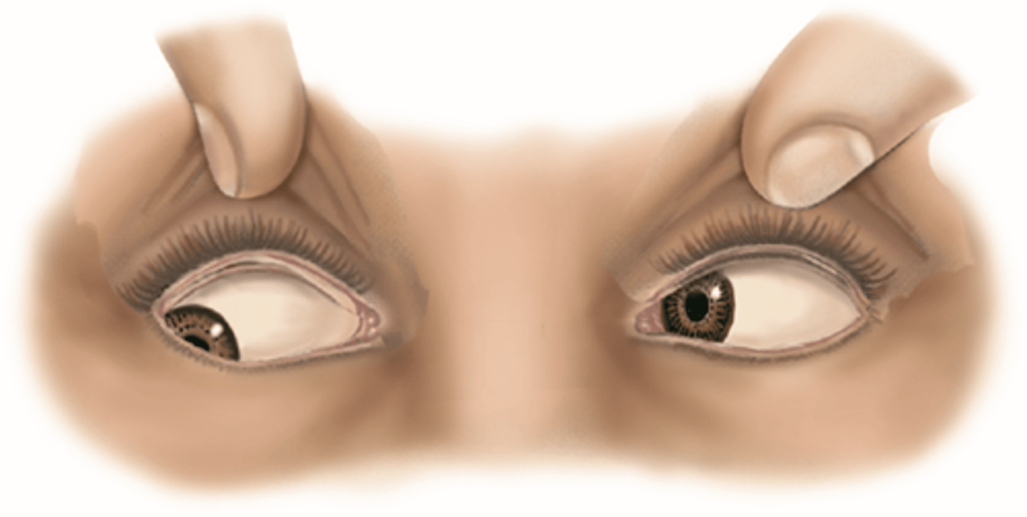 <p><u>Etio</u>: due to <strong>lesion</strong></p><p><u>S&amp;S</u>: diplopia, <strong>lack of SO4</strong> movement</p><p><u>Testing</u>: MRI to r/o lesion</p><p><u>Tx</u>: Emergent consult neurosurgeon</p>