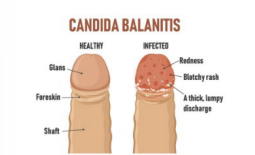 <p><strong>Balanitis</strong></p><p>-Pain, _________, and inflammation of the _____ penis</p><p>-Can be caused by _______ (MC), bacteria, or dermatologic condition</p>
