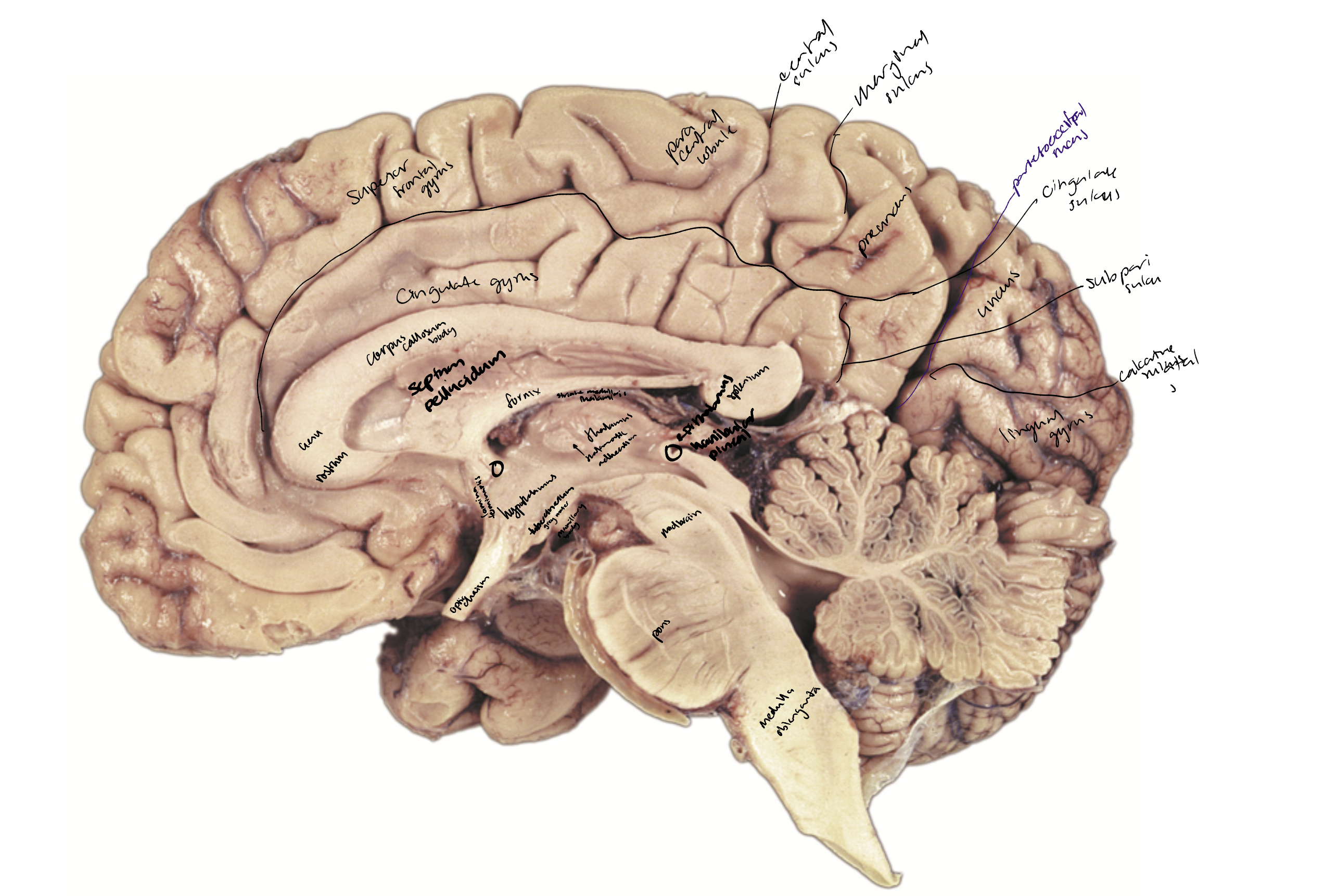 <ul><li><p>The cingulate gyrus </p></li><li><p>The callosal sulcus&nbsp; </p></li><li><p>The cingulate sulcus </p></li><li><p>The cingulate sulcus marginal branch </p></li><li><p>The subparietal sulcus </p></li><li><p>The calcarine sulcus </p></li><li><p>The parietooccipital sulcus </p></li><li><p>Posterior paracental lobule</p></li><li><p> Precuneus </p></li><li><p>Cuneus </p></li><li><p>Lingual gyrus </p></li><li><p>Collateral sulcus </p></li><li><p>The occipitotemporal gyrus</p></li></ul><p></p>