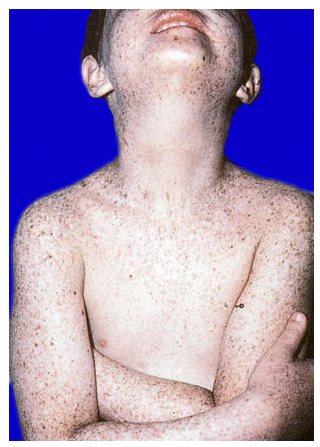 <p>2-yr hx of easy sunburns (after 15 min) &amp; redness of both eyes outside. what is he at risk for?</p>