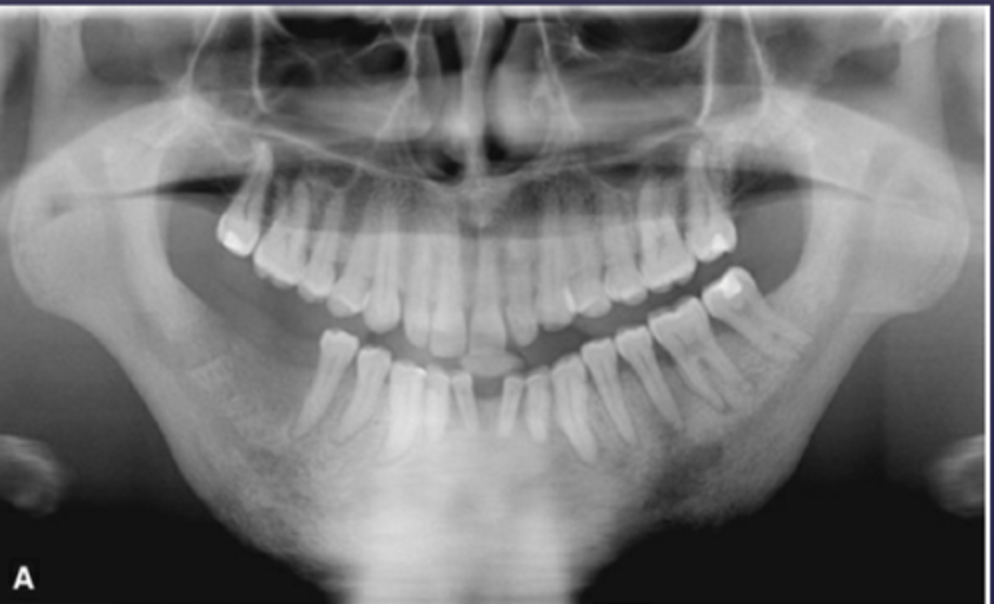 <p>A patient's pano is shown and presents with wrist symptoms. What is the differential diagnosis?</p>