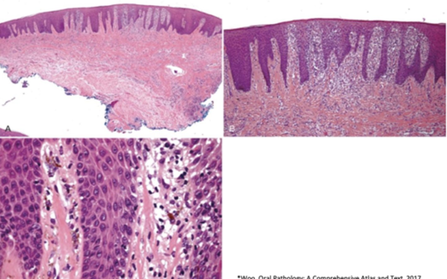 <p>What is a similar type of pigmented lesion to melanotic macules but have inflammation?</p>