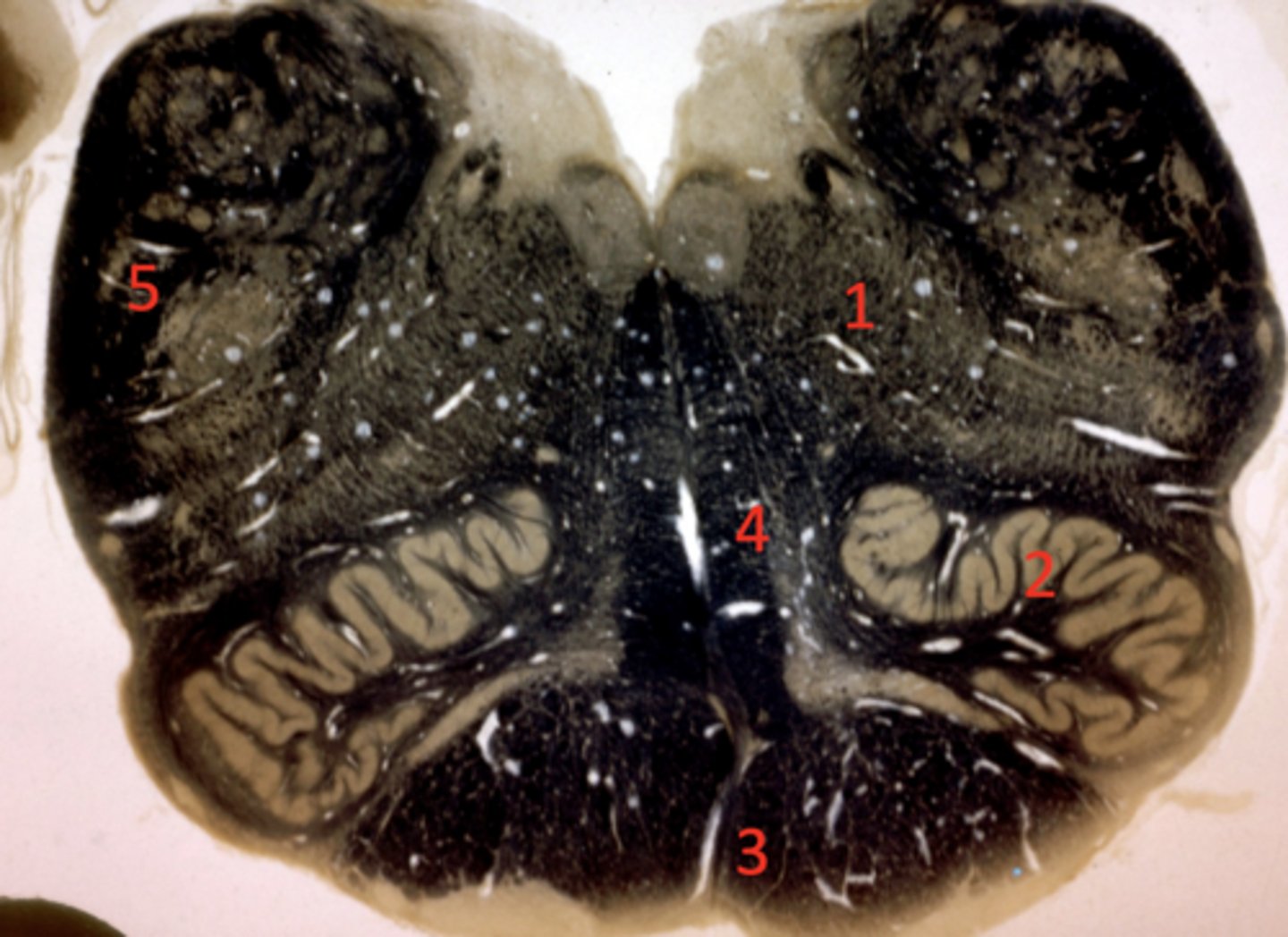 <p>inferior cerebellar peduncle</p>