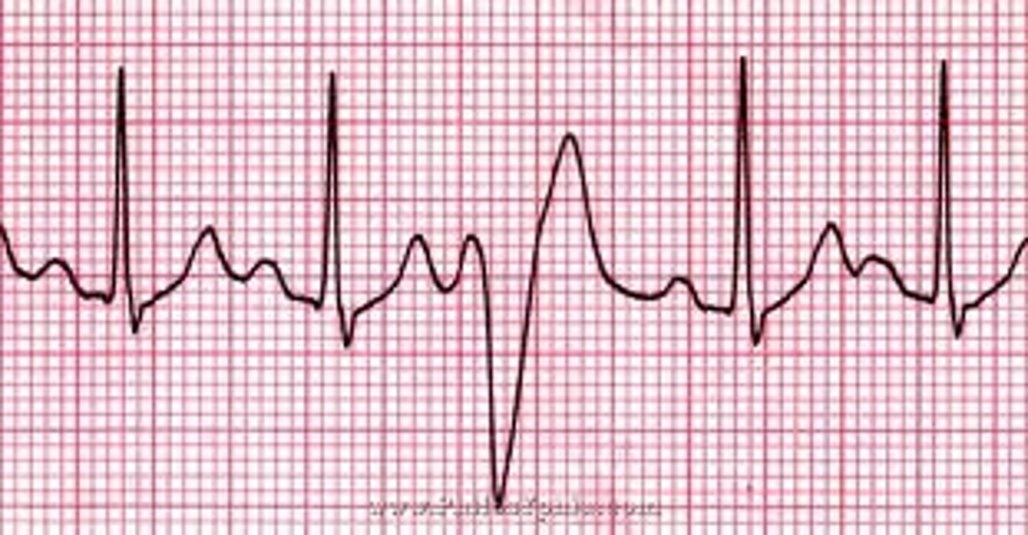 <p>The absence of a P wave</p><p>The absence of a P wave in this tracing is related to a premature ventricular complex, which can be a sign of ischemia within the ventricles. Low cardiac output can result from frequent PVCs and need to be address promptly.</p>