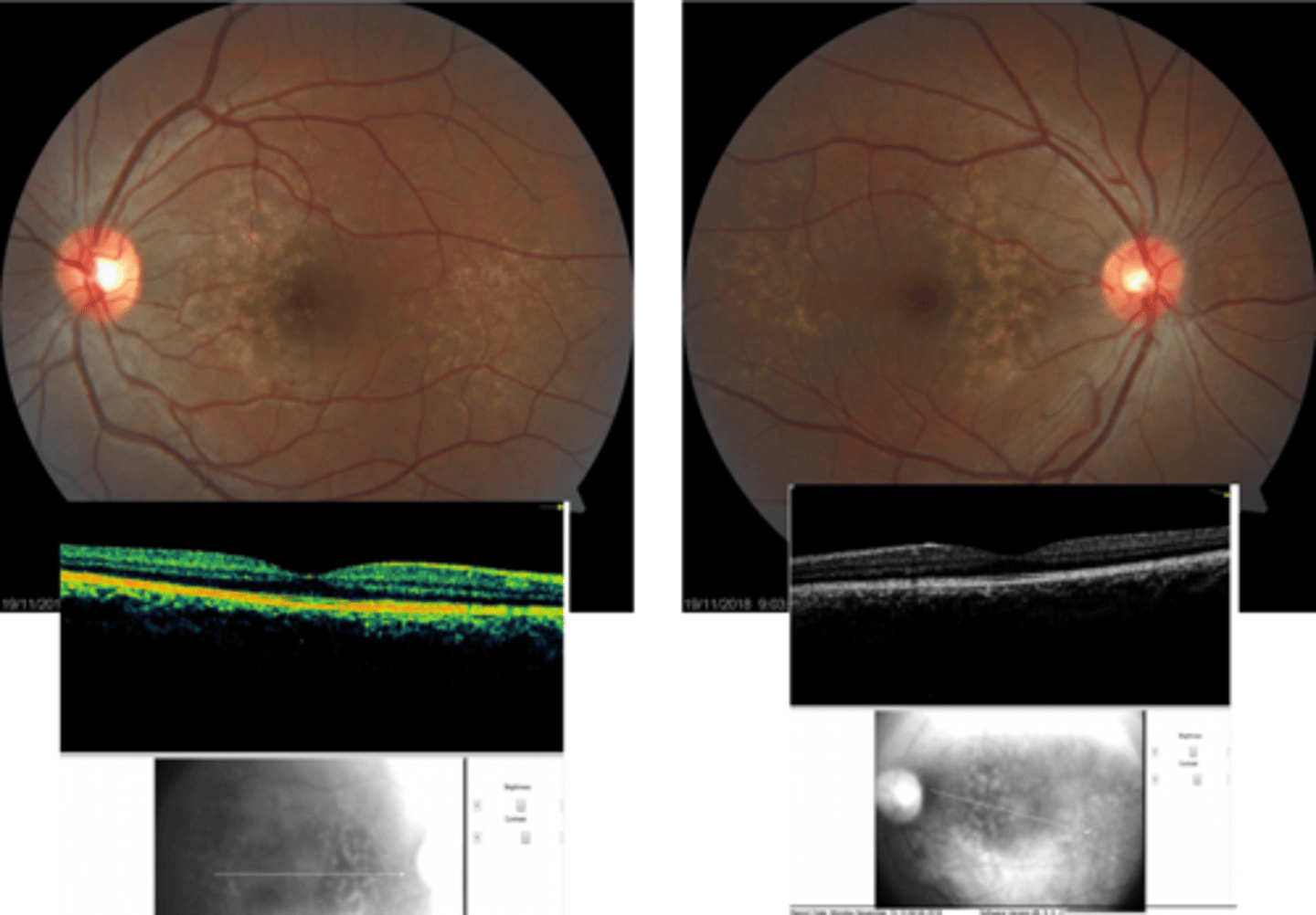 <p>patterned grouping of drusen in outer macular or midperiphery = part of AMD spectrum but NO increased risk of CNV/GA</p>