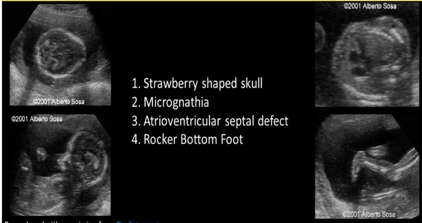 <p>which trisomy is most commonly assoc w<strong>/strawberry shaped</strong> fetal skull</p><p>a) 9</p><p>b) 18</p><p>c) 13</p><p>d) 21</p>