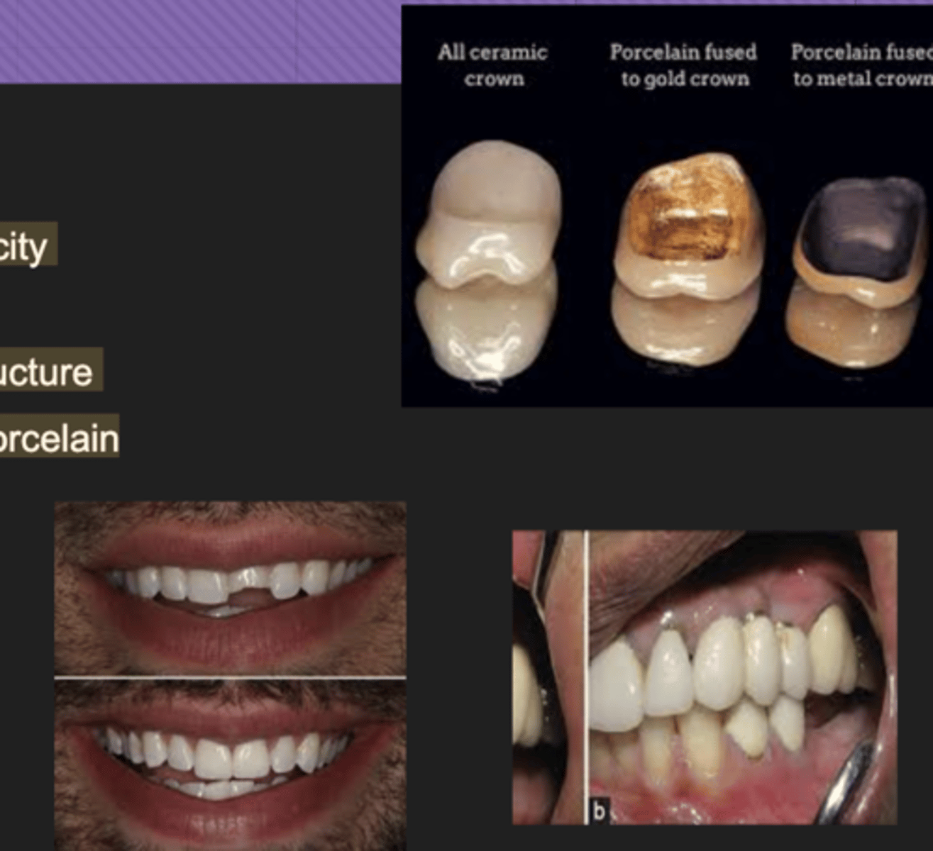 <p>- Varying shades of radiopacity</p><p>- &gt; Halo</p><p>- Many have a metal substructure</p><p>- Some crowns can be all porcelain</p>